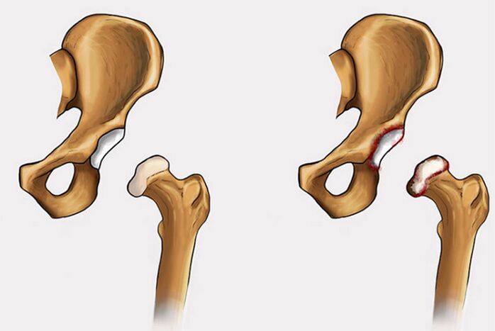 cambiamenti degenerativi e dolore all'articolazione dell'anca