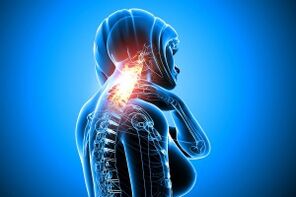 Osteocondrosi nella colonna cervicale