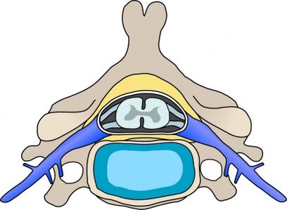 Protabio nelle vertebre con osteocondosi cervicale