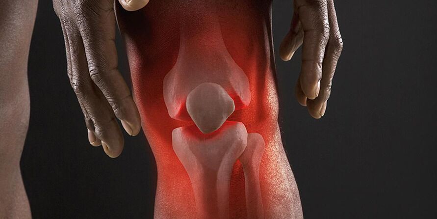 Una sensazione di bruciore nella zona del ginocchio è un sintomo di gonartrosi